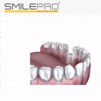 Top Dental Implants in Pune  by smilepro